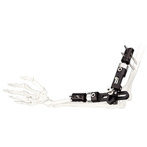 Unilateral Frame External Fixation Device for Elbow Wrist