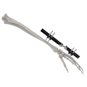 CANWELL Wrist External Fixator Small Bones Fracture Fixation