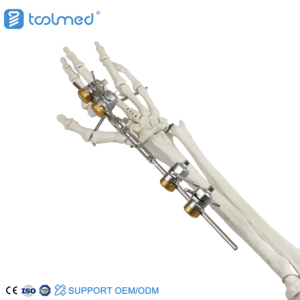 Wrist Joint External Fixator Surgical Fixator System