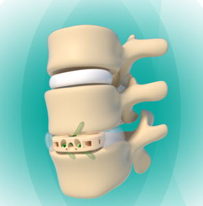 FULE Posterior Lumbar Interbody Fusion Cage Spine Orthopedic Implants ALIF PEEK Class III CE Certified 5-Year Warranty